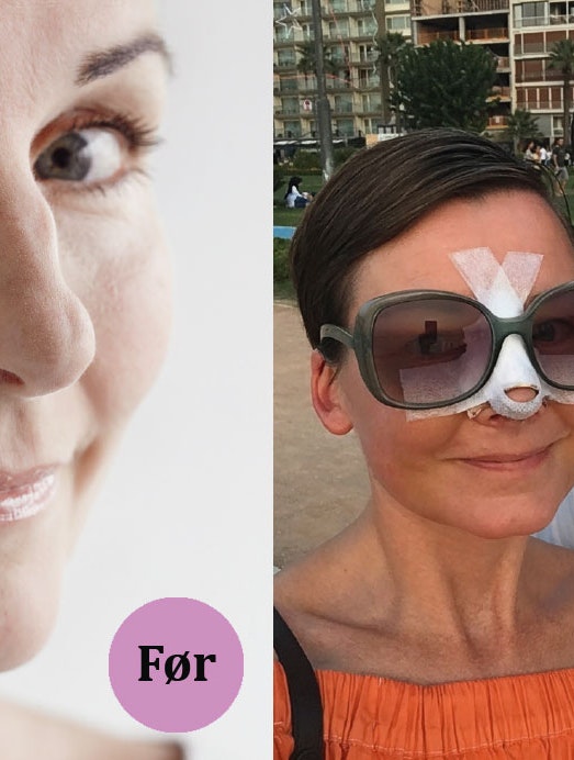 næseoperation før og efter