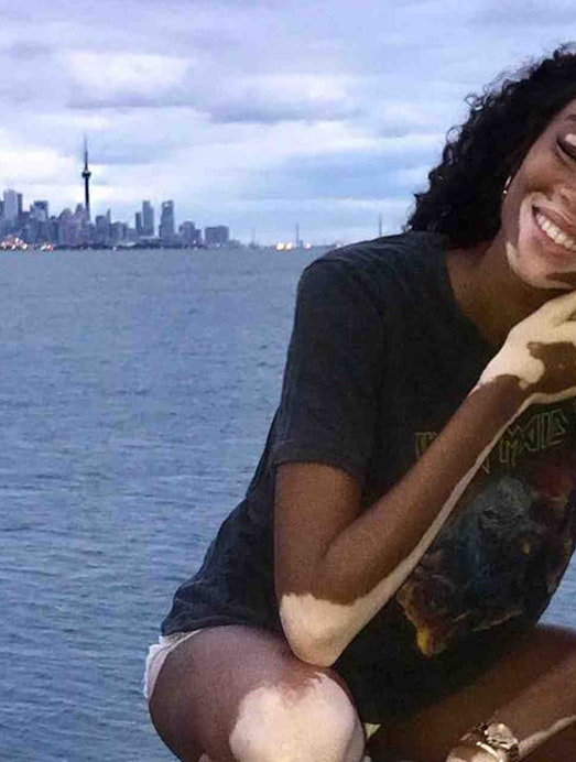 Winnie Harlow