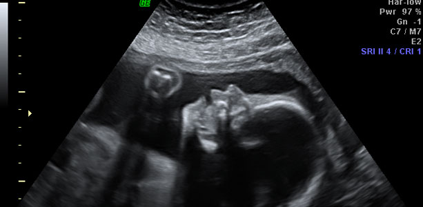 tynd galop pubertet Gravid uge 25: Hver dag i livmoderen er en gave mama.dk